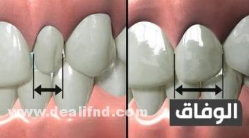 علاج بروز الأسنان الأمامية بالأعشاب