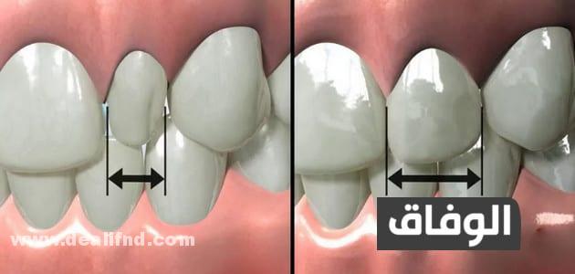 علاج بروز الأسنان الأمامية بالاعشاب