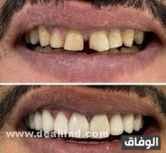 علاج بروز الأسنان الأمامية بالاعشاب