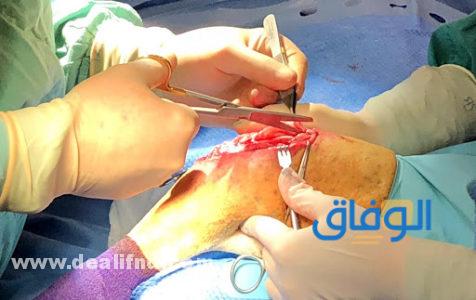 العلاج الجراحي للقطع الجزئي في الرباط الصليبي