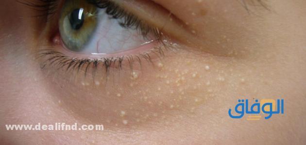 ما سبب ظهور حبوب صغيرة نفس لون الجلد في الوجه