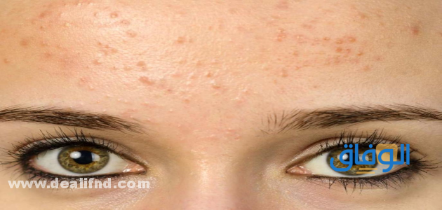 ما سبب ظهور حبوب صغيرة نفس لون الجلد في الوجه