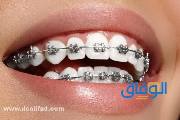 اسعار تقويم الأسنان في مصر 2024